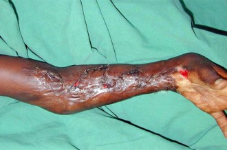 Sénégal : Il asperge ses enfants dÂ’acide et dit lÂ’avoir confondu avec de lÂ’eau bénite